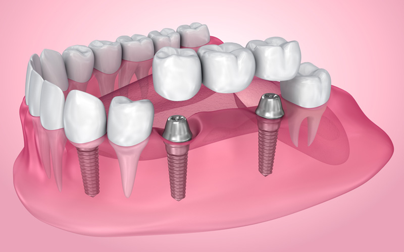 dental implants in yaletown vancouver