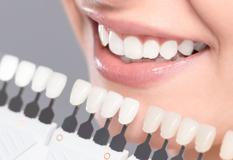 teeth whitening in yaletown vancouver