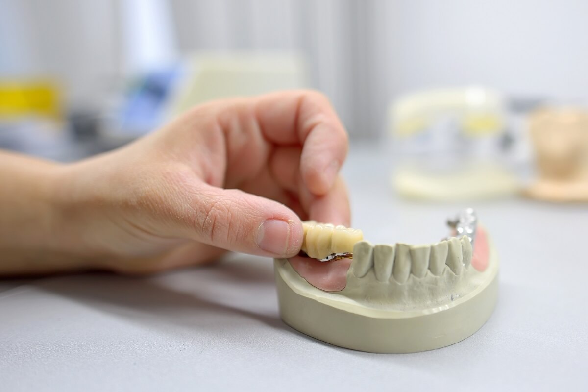Dental Crowns and Bridges for Missing Teeth